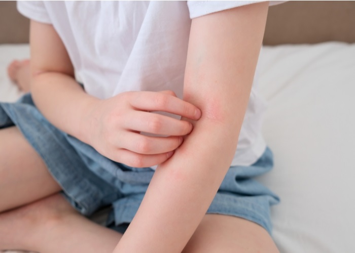 psoriasis on a kids arm